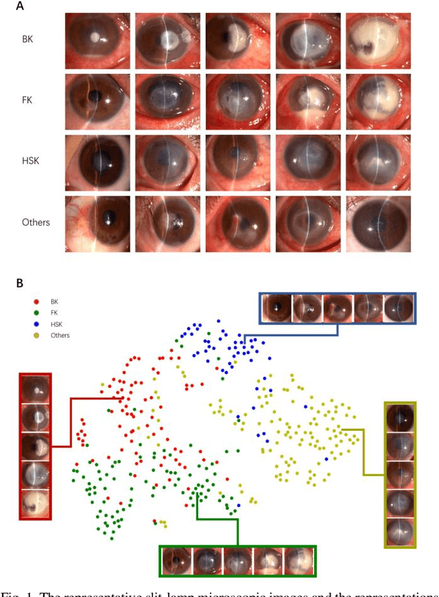 Figure 1 for Deep Sequential Feature Learning in Clinical Image Classification of Infectious Keratitis