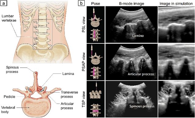 Figure 1 for Image-Guided Navigation of a Robotic Ultrasound Probe for Autonomous Spinal Sonography Using a Shadow-aware Dual-Agent Framework