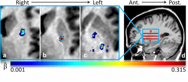 Figure 3 for Tensor-Based Grading: A Novel Patch-Based Grading Approach for the Analysis of Deformation Fields in Huntington's Disease