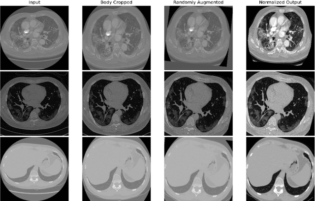 Figure 1 for Rapid quantification of COVID-19 pneumonia burden from computed tomography with convolutional LSTM networks
