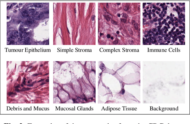 Figure 3 for Learning with less data via Weakly Labeled Patch Classification in Digital Pathology