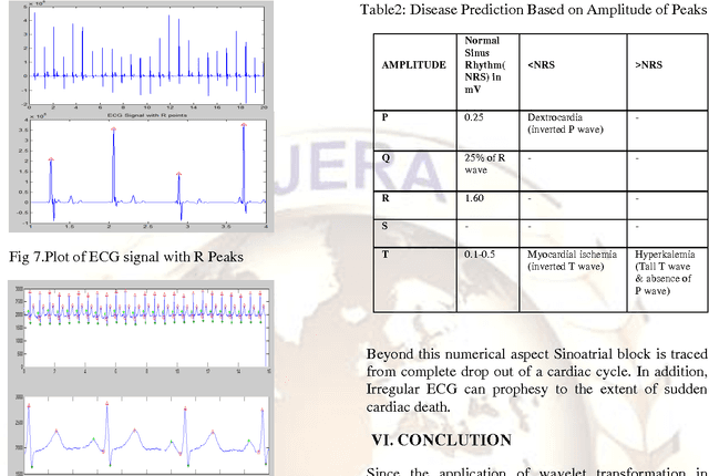 Figure 3 for Wavelet Based QRS Complex Detection of ECG Signal