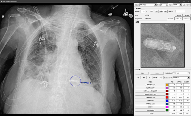 Figure 1 for Cascading Neural Network Methodology for Artificial Intelligence-Assisted Radiographic Detection and Classification of Lead-Less Implanted Electronic Devices within the Chest