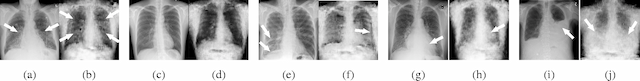 Figure 4 for Generalization of Deep Neural Networks for Chest Pathology Classification in X-Rays Using Generative Adversarial Networks