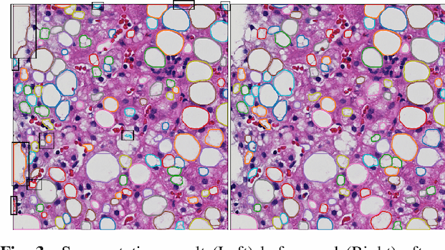 Figure 4 for Liver Steatosis Segmentation with Deep Learning Methods