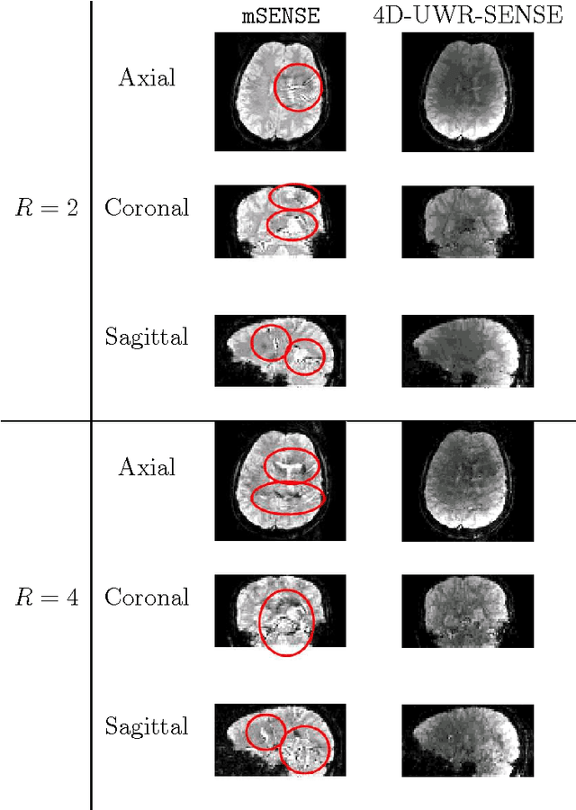 Figure 3 for 4D Wavelet-Based Regularization for Parallel MRI Reconstruction: Impact on Subject and Group-Levels Statistical Sensitivity in fMRI