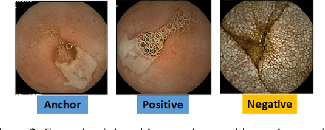 Figure 3 for Lesion2Vec: Deep Metric Learning for Few-Shot Multiple Lesions Recognition in Wireless Capsule Endoscopy Video