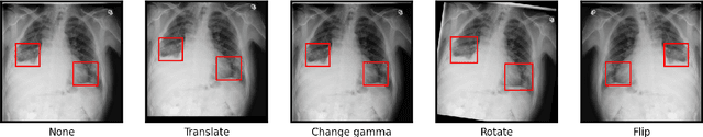 Figure 1 for Reducing Labelled Data Requirement for Pneumonia Segmentation using Image Augmentations
