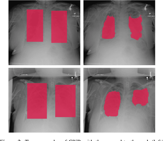Figure 3 for Reducing Labelled Data Requirement for Pneumonia Segmentation using Image Augmentations