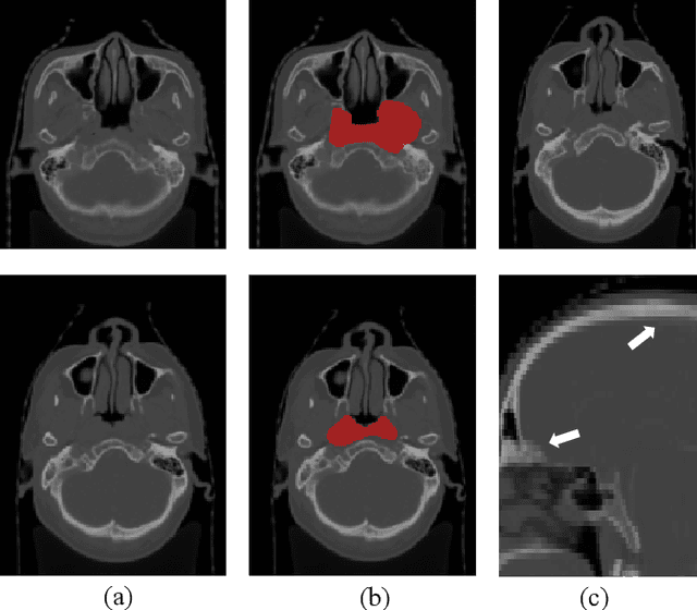 Figure 1 for Automatic Segmentation of Gross Target Volume of Nasopharynx Cancer using Ensemble of Multiscale Deep Neural Networks with Spatial Attention