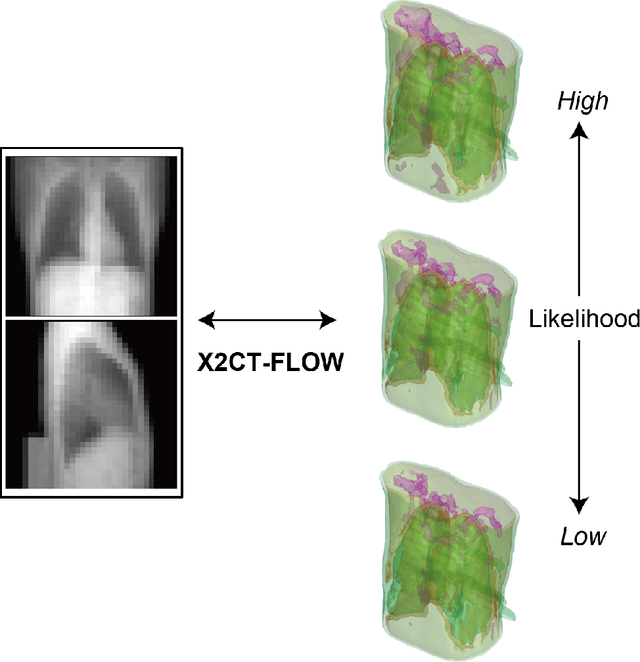 Figure 1 for X2CT-FLOW: Reconstruction of multiple volumetric chest computed tomography images with different likelihoods from a uni- or biplanar chest X-ray image using a flow-based generative model