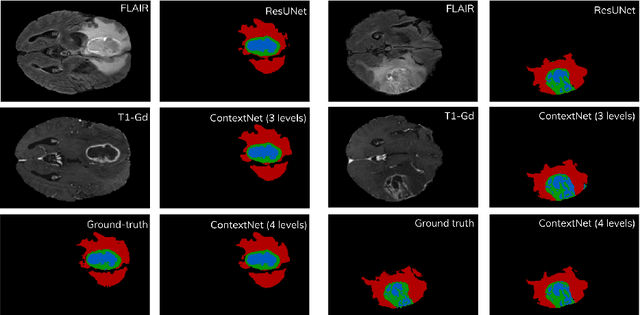 Figure 4 for Global Planar Convolutions for improved context aggregation in Brain Tumor Segmentation