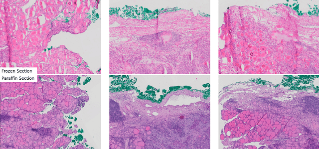 Figure 1 for Frozen-to-Paraffin: Categorization of Histological Frozen Sections by the Aid of Paraffin Sections and Generative Adversarial Networks
