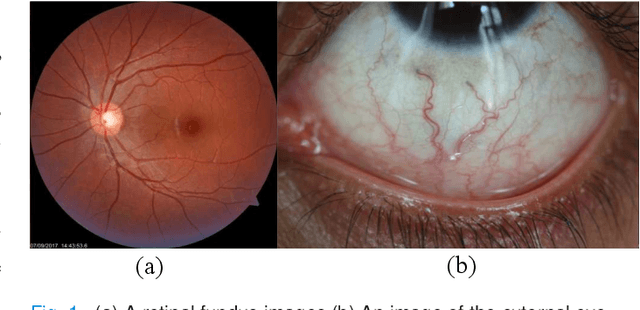 Figure 1 for A Thickness Sensitive Vessel Extraction Framework for Retinal and Conjunctival Vascular Tortuosity Analysis