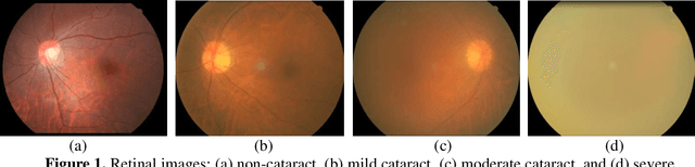 Figure 1 for Hierarchical method for cataract grading based on retinal images using improved Haar wavelet