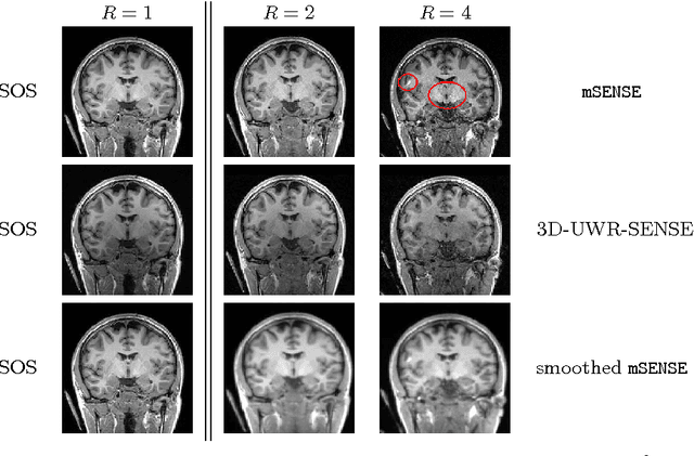 Figure 1 for Spatio-temporal wavelet regularization for parallel MRI reconstruction: application to functional MRI