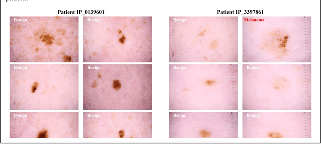 Figure 1 for A Patient-Centric Dataset of Images and Metadata for Identifying Melanomas Using Clinical Context