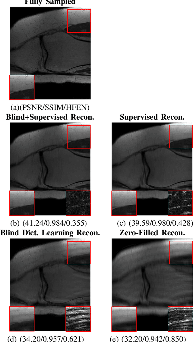 Figure 4 for Blind Primed Supervised (BLIPS) Learning for MR Image Reconstruction