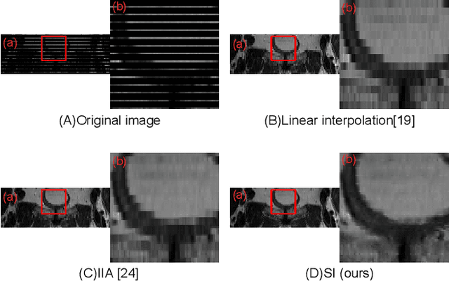 Figure 1 for Slice Imputation: Intermediate Slice Interpolation for Anisotropic 3D Medical Image Segmentation