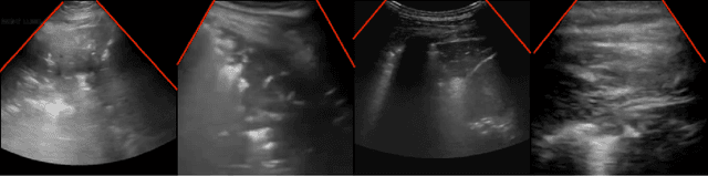 Figure 1 for COVID-Net US-X: Enhanced Deep Neural Network for Detection of COVID-19 Patient Cases from Convex Ultrasound Imaging Through Extended Linear-Convex Ultrasound Augmentation Learning
