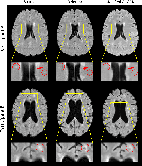 Figure 3 for Temporally Adjustable Longitudinal Fluid-Attenuated Inversion Recovery MRI Estimation / Synthesis for Multiple Sclerosis
