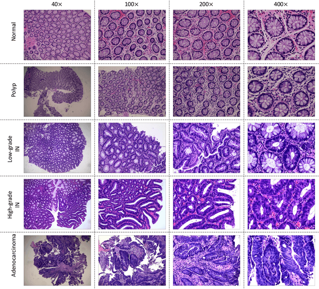 Figure 3 for EBHI:A New Enteroscope Biopsy Histopathological H&E Image Dataset for Image Classification Evaluation