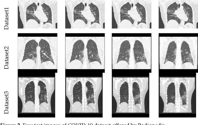 Figure 3 for Harmony-Search and Otsu based System for Coronavirus Disease (COVID-19) Detection using Lung CT Scan Images