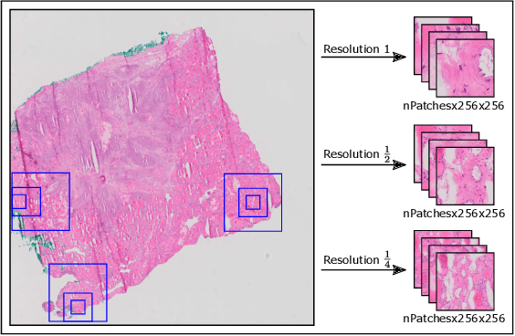 Figure 1 for Evaluation of Multi-Scale Multiple Instance Learning to Improve Thyroid Cancer Classification