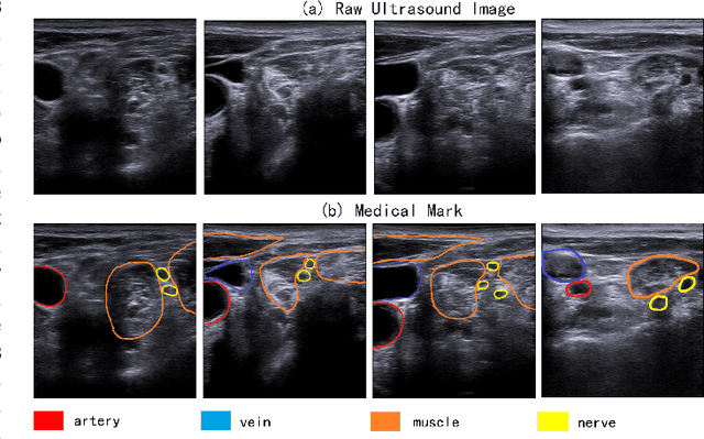 Figure 1 for Multiple Instance Segmentation in Brachial Plexus Ultrasound Image Using BPMSegNet