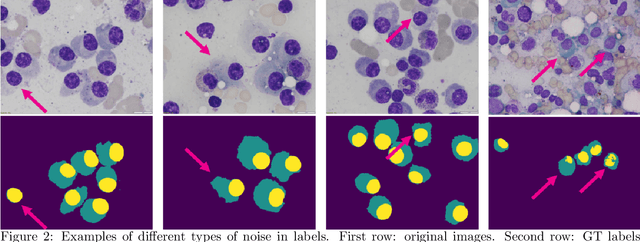 Figure 3 for Segmentation of Multiple Myeloma Plasma Cells in Microscopy Images with Noisy Labels