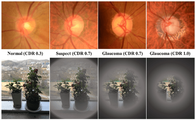 Figure 1 for TRk-CNN: Transferable Ranking-CNN for image classification of glaucoma, glaucoma suspect, and normal eyes