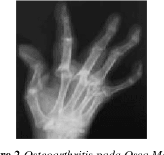 Figure 2 for Osteoarthritis Disease Detection System using Self Organizing Maps Method based on Ossa Manus X-Ray