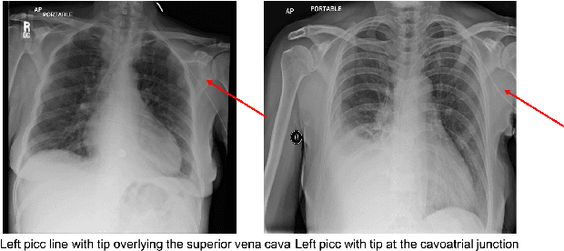 Figure 3 for Building a Benchmark Dataset and Classifiers for Sentence-Level Findings in AP Chest X-rays