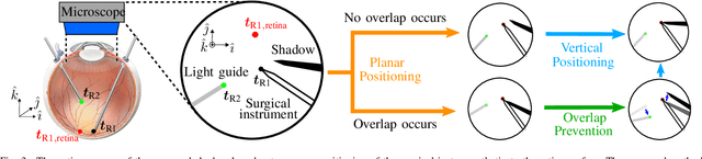 Figure 3 for Autonomous Coordinated Control of the Light Guide for Positioning in Vitreoretinal Surgery