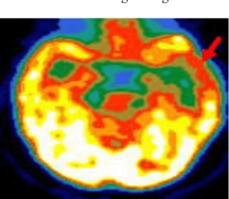 Figure 2 for Symmetry Based Cluster Approach for Automatic Recognition of the Epileptic Focus in Brain Using PET Scan Image : An Analysis