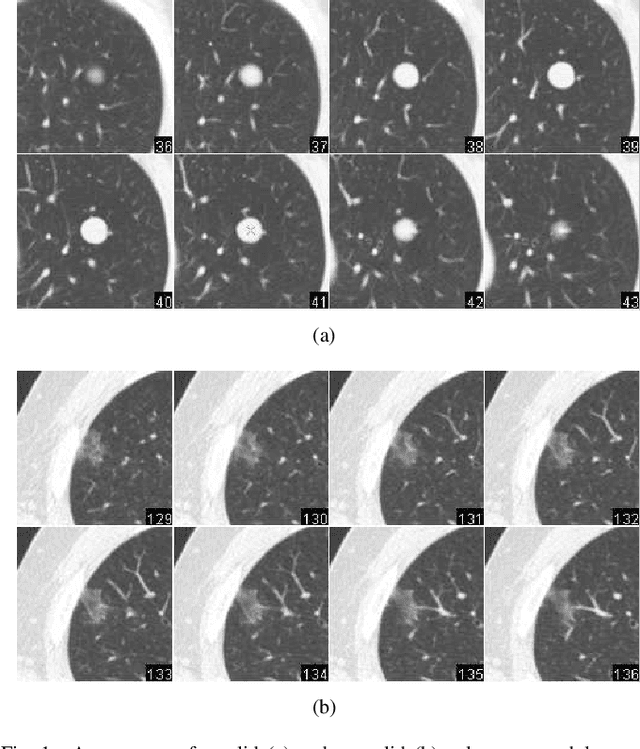 Figure 1 for A multiscale Laplacian of Gaussian (LoG) filtering approach to pulmonary nodule detection from whole-lung CT scans