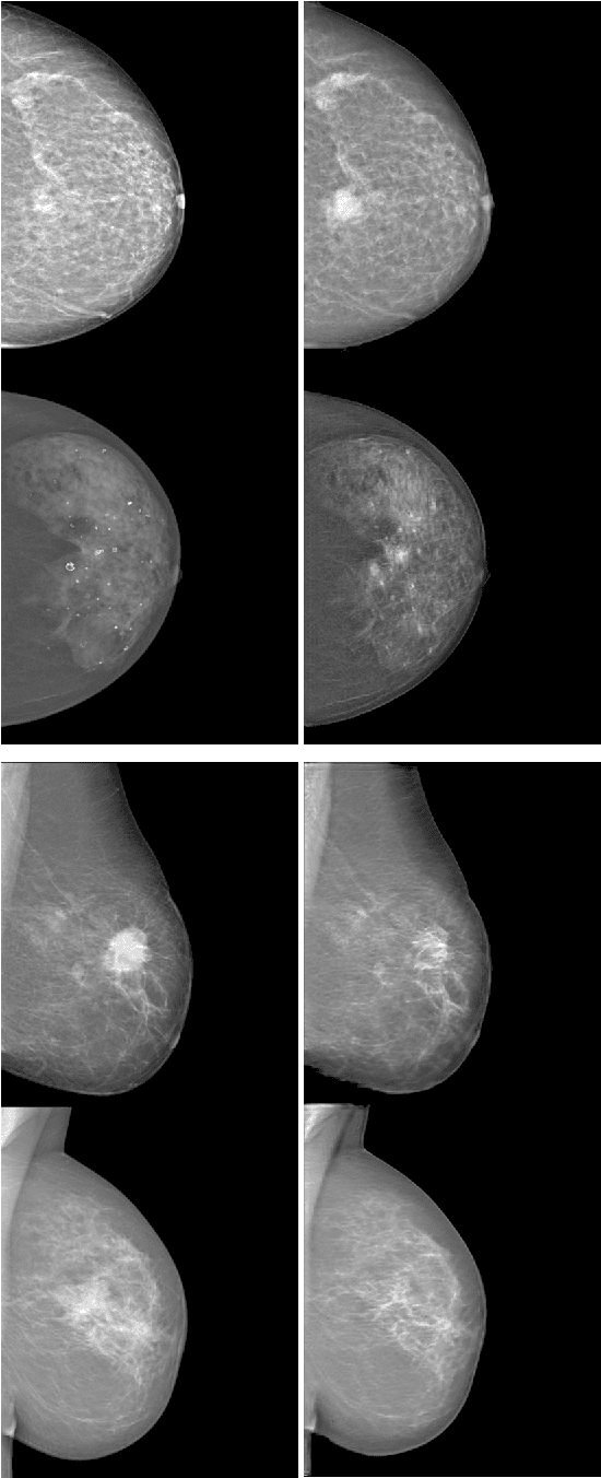 Figure 3 for Injecting and removing malignant features in mammography with CycleGAN: Investigation of an automated adversarial attack using neural networks