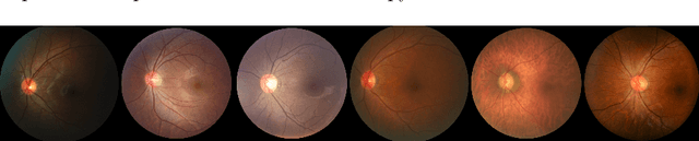 Figure 1 for Multiscale Softmax Cross Entropy for Fovea Localization on Color Fundus Photography