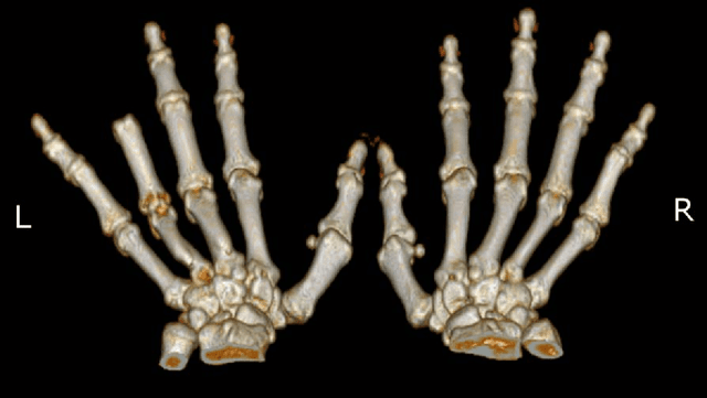 Figure 2 for Patient-Specific Prosthetic Fingers by Remote Collaboration - A Case Study