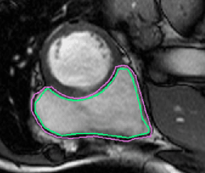 Figure 1 for Pixel-wise Segmentation of Right Ventricle of Heart