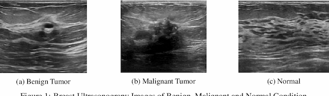 Figure 1 for Deep Integrated Pipeline of Segmentation Leading to Classification for Automated Detection of Breast Cancer from Breast Ultrasound Images