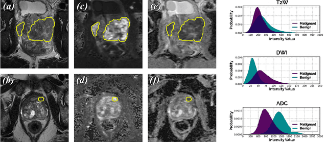 Figure 1 for End-to-end Prostate Cancer Detection in bpMRI via 3D CNNs: Effect of Attention Mechanisms, Clinical Priori and Decoupled False Positive Reduction