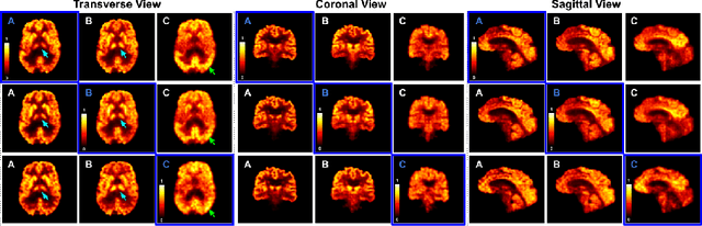 Figure 3 for Synthesizing Multi-Tracer PET Images for Alzheimer's Disease Patients using a 3D Unified Anatomy-aware Cyclic Adversarial Network