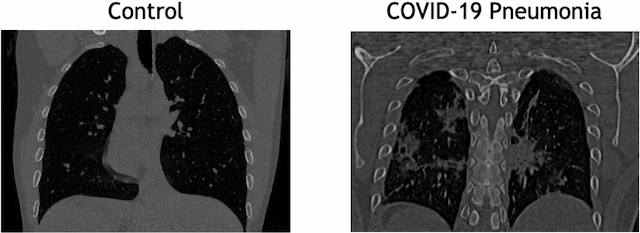 Figure 1 for Probabilistic combination of eigenlungs-based classifiers for COVID-19 diagnosis in chest CT images