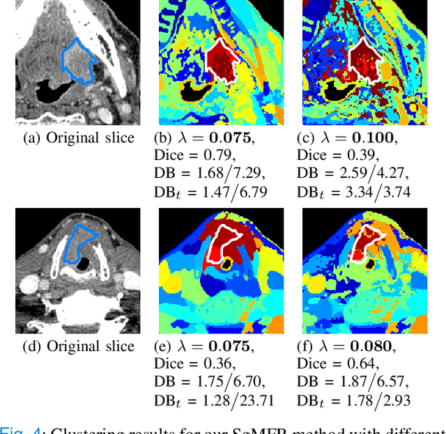 Figure 3 for Spectral image clustering on dual-energy CT scans using functional regression mixtures