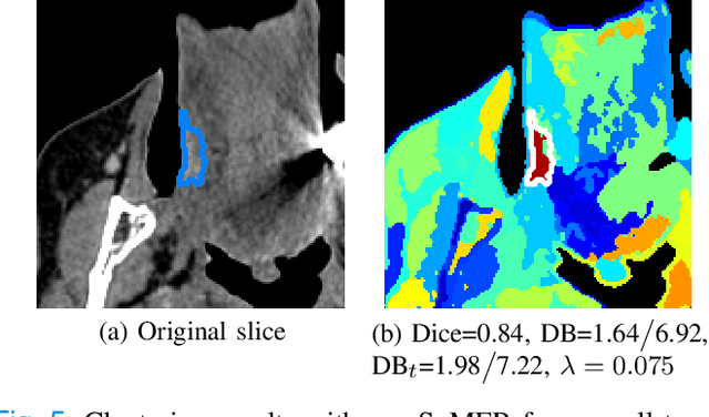 Figure 4 for Spectral image clustering on dual-energy CT scans using functional regression mixtures