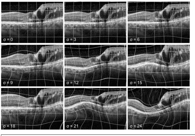 Figure 1 for Elastic deformation of optical coherence tomography images of diabetic macular edema for deep-learning models training: how far to go?