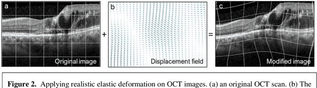 Figure 3 for Elastic deformation of optical coherence tomography images of diabetic macular edema for deep-learning models training: how far to go?