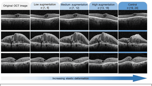 Figure 4 for Elastic deformation of optical coherence tomography images of diabetic macular edema for deep-learning models training: how far to go?