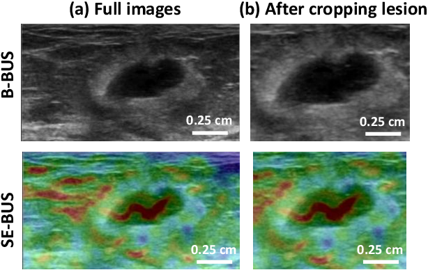 Figure 1 for Ensemble Transfer Learning of Elastography and B-mode Breast Ultrasound Images